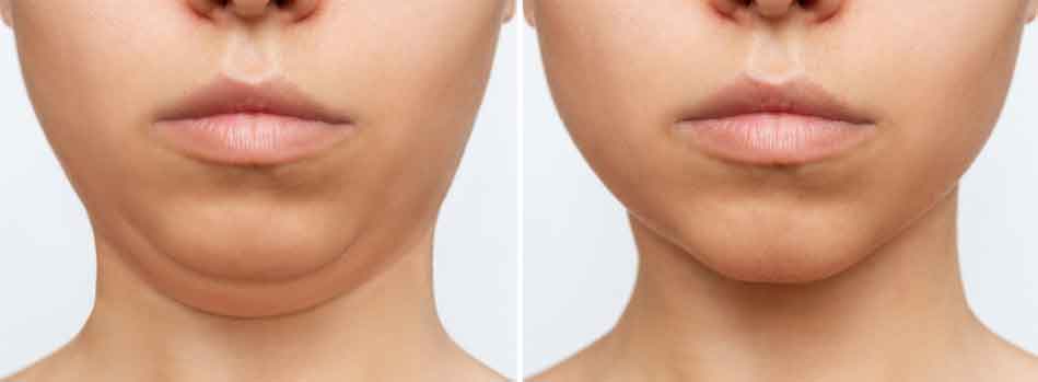 Face Lift and Neck Lift | Asteria: Centre for Aesthetics Surgery