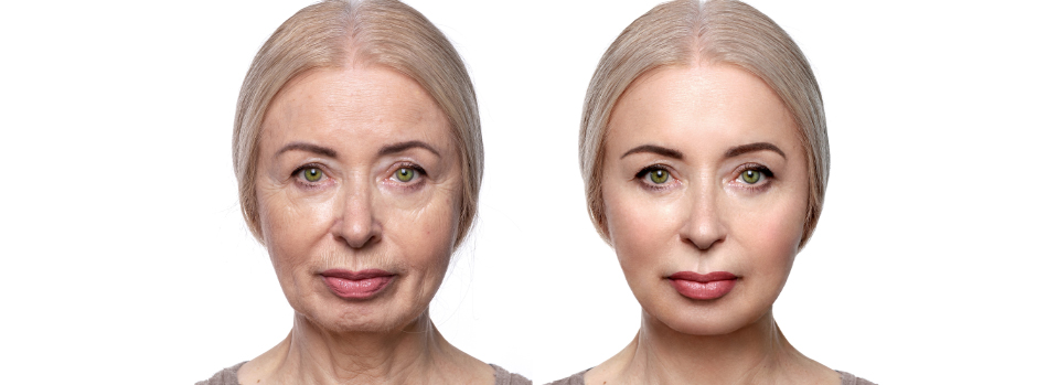 Fillers & Botox | Asteria: Centre for Aesthetics Surgery